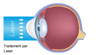 schéma scientifique de l'oeil et de l'astigmatisme