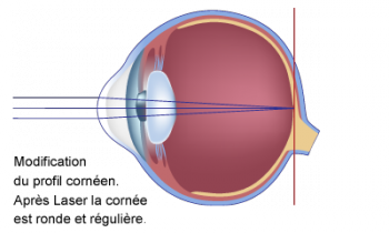 schéma astigmatisme