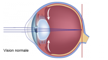 schéma de la vision normale cataracte