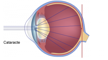 schéma de la cataracte