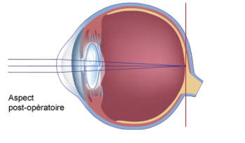 schéma de l'aspect post operatoire de la cataracte