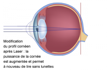 schéma d'un oeil presbyte